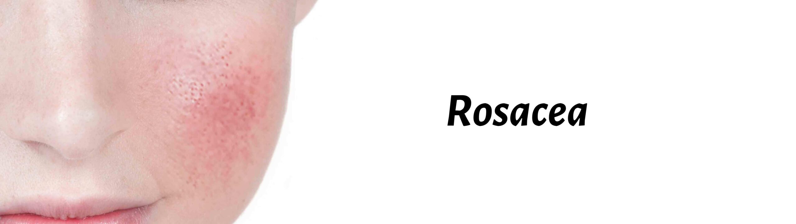 Rosacea